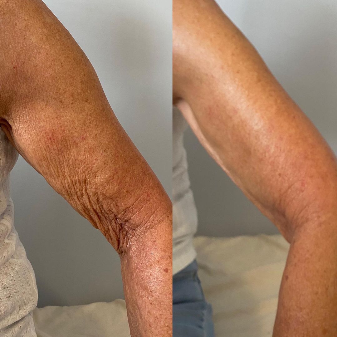 Henry™ Skin Device + Conductive Gel